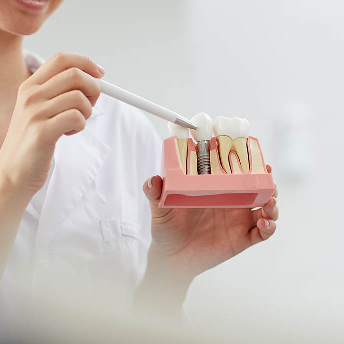 Dental Implants
